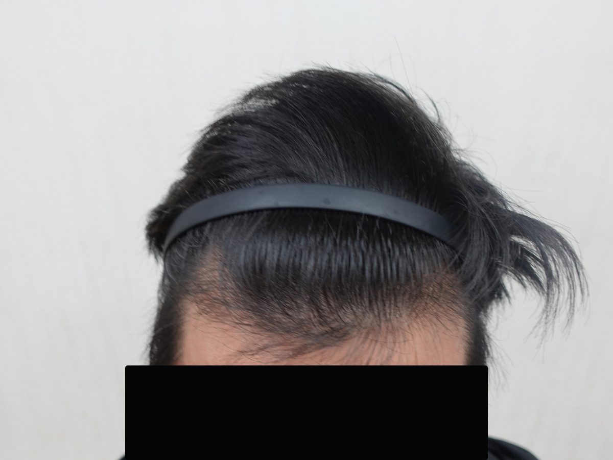 澳門 40 歲男性前額俯視療程前與後續影像:植髮後