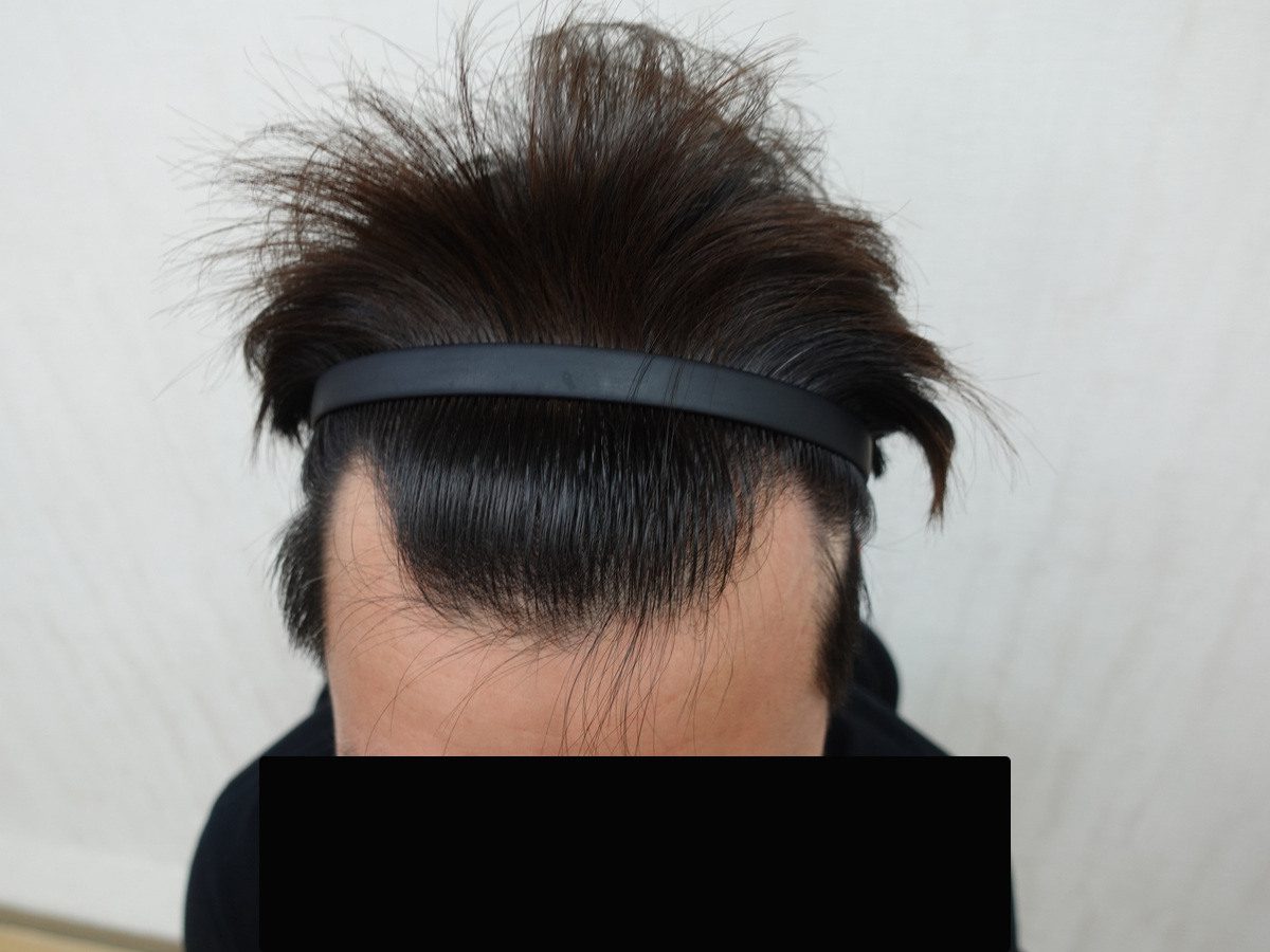 澳門 40 歲男性前額俯視療程前與後續影像:植髮前