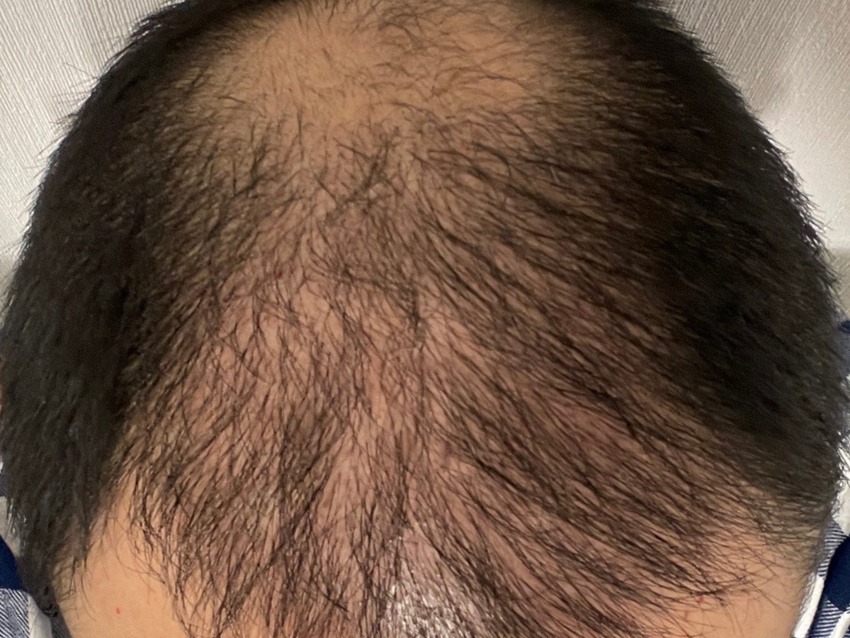 男性頭頂髮旋術後約 7 個月俯視影像