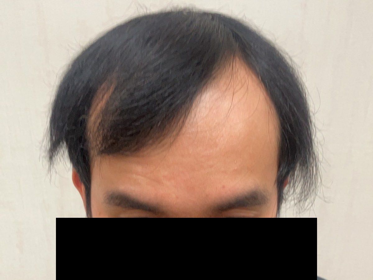 男性前額髮際線術前與約七個月後正面影像:植髮前