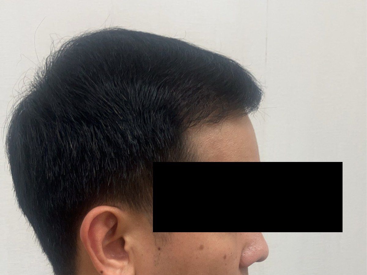 男性右側額角術前與約七個月後影像:植髮後