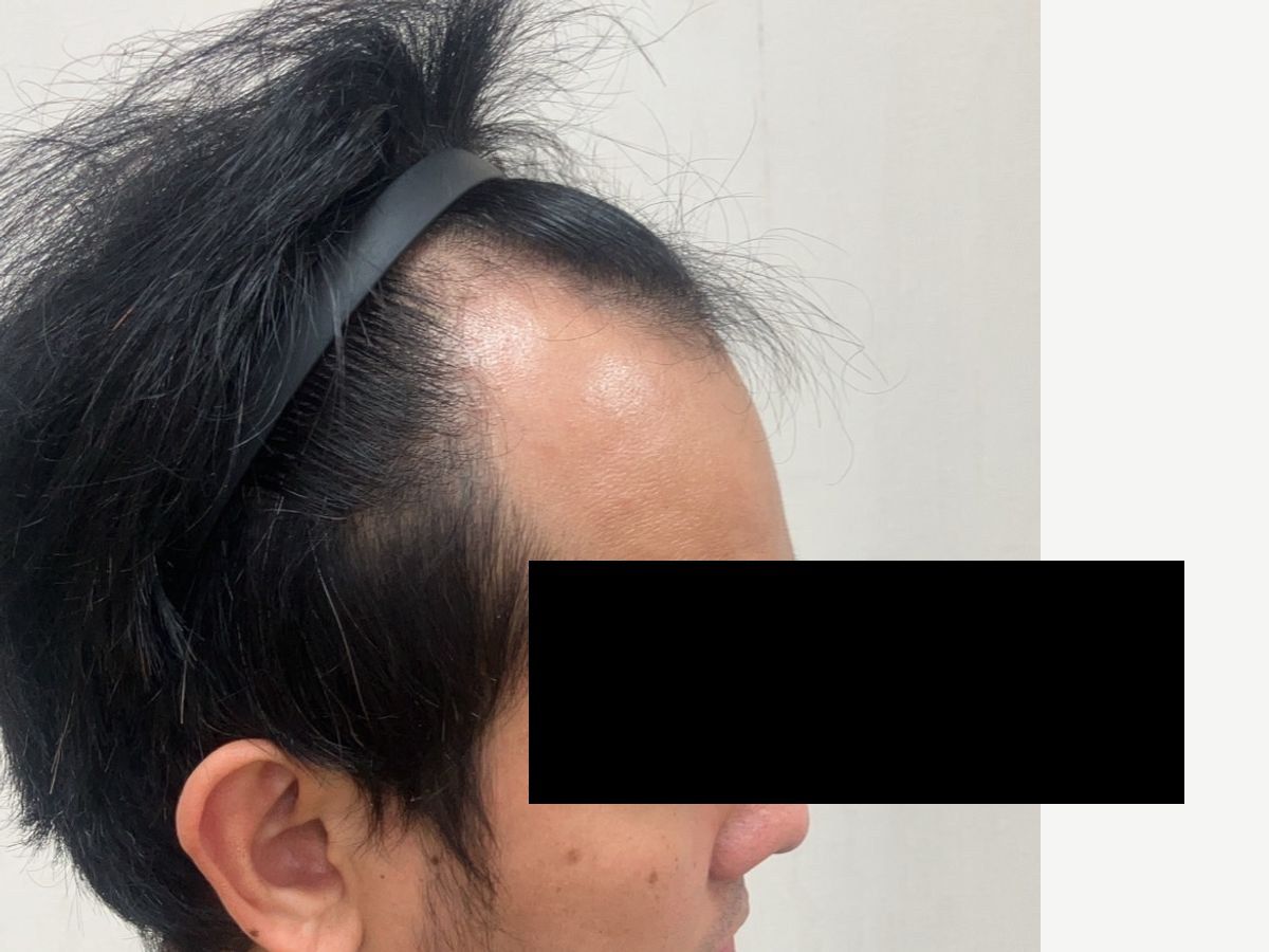 男性右側額角術前與約七個月後影像:植髮前