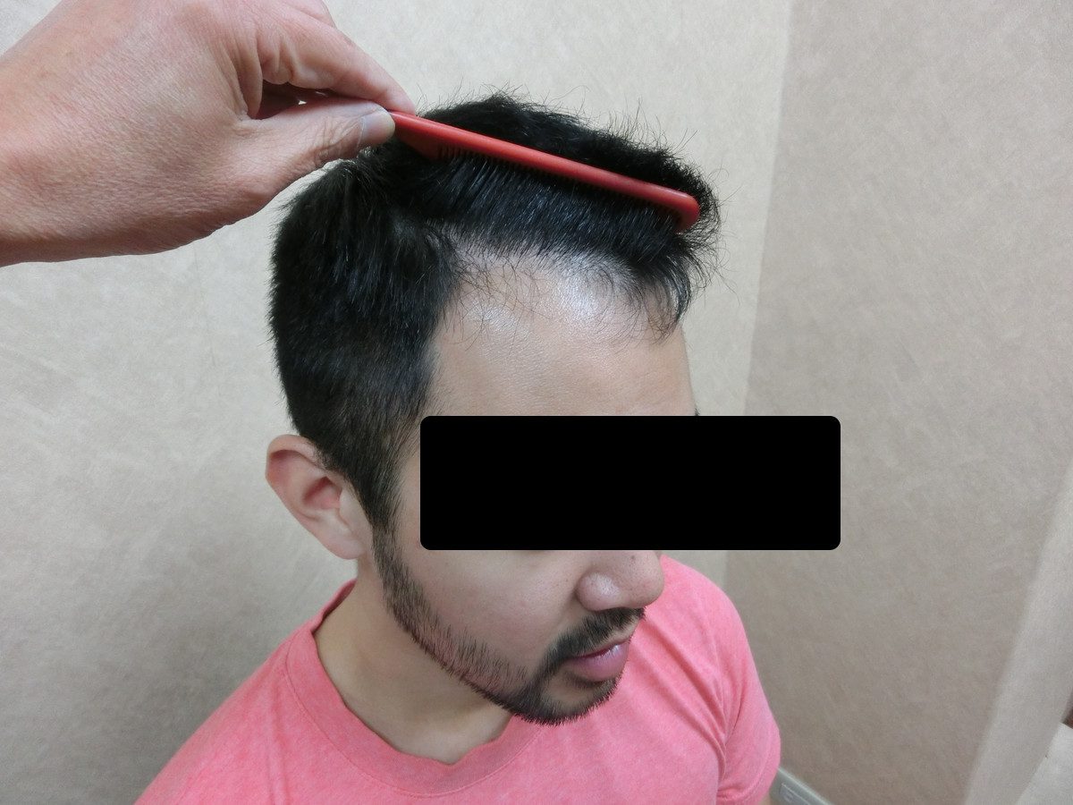 FUE 1523 株左側額角療程前與約 7 個月追蹤:植髮後
