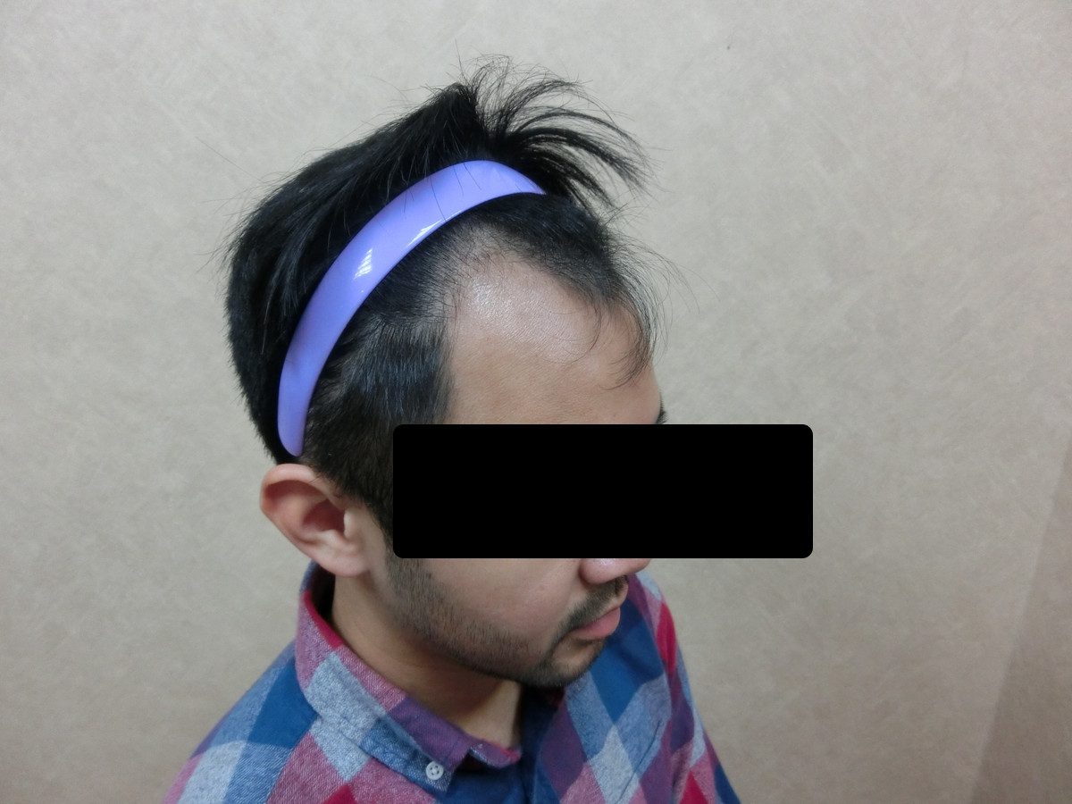 FUE 1523 株左側額角療程前與約 7 個月追蹤:植髮前