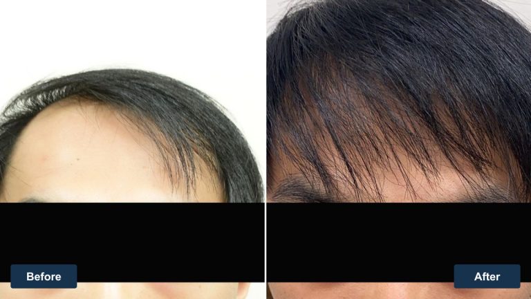 台灣 30 歲男性前額至髮旋植髮案例｜雙角度影像紀錄