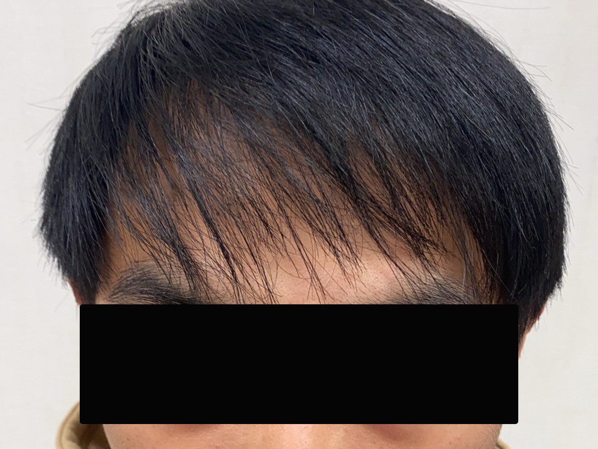 台灣 30 歲男性正面髮際線療程前與後續影像:植髮後