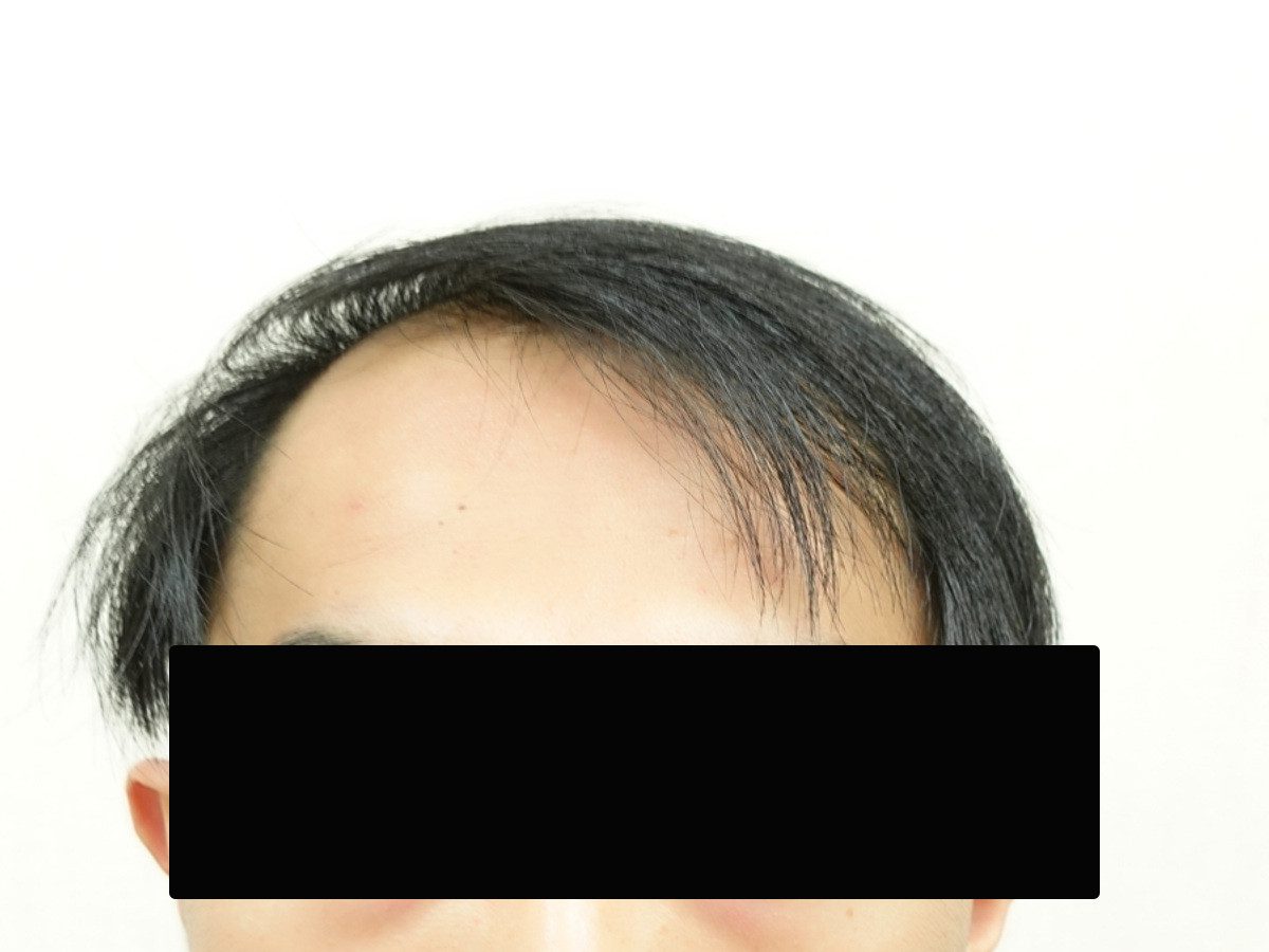 台灣 30 歲男性正面髮際線療程前與後續影像:植髮前