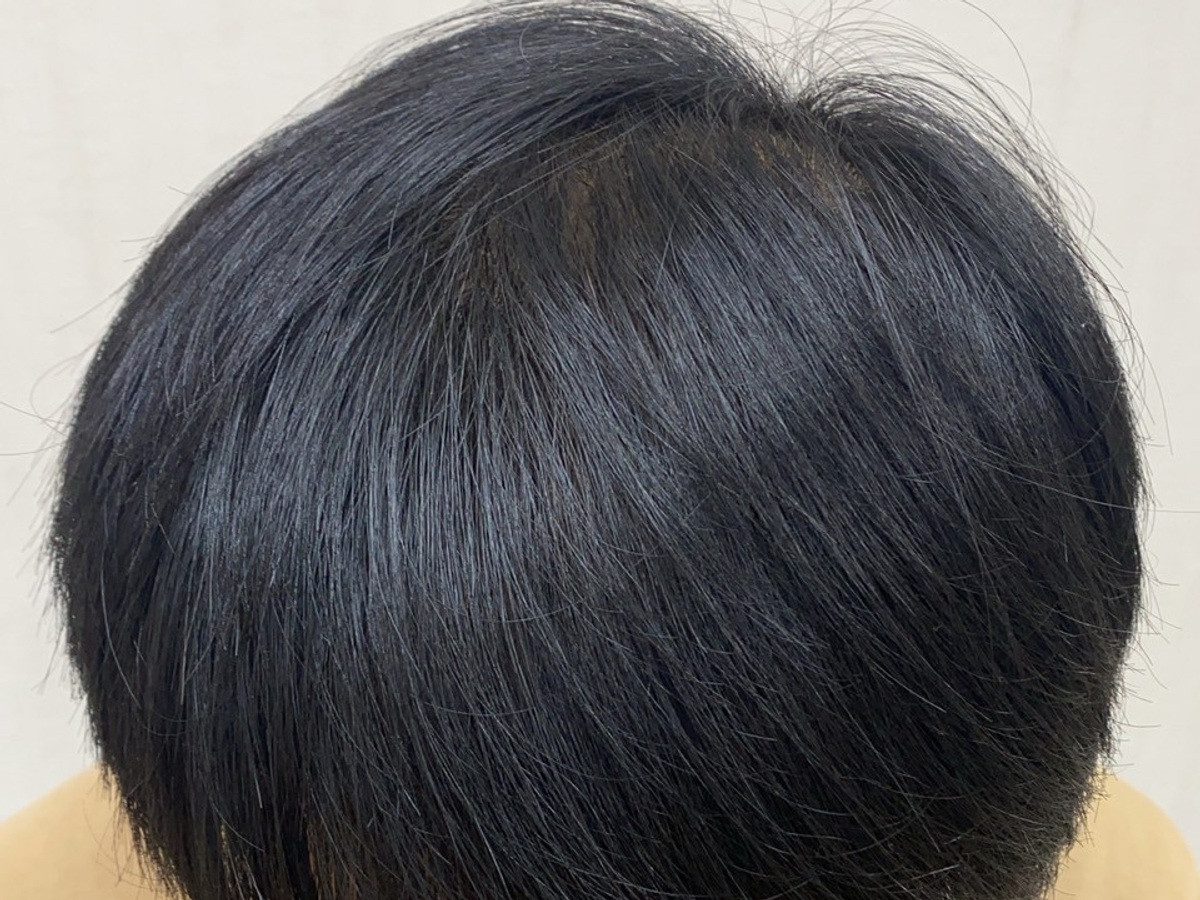 台灣 30 歲男性上方頭頂療程前與後續影像:植髮後
