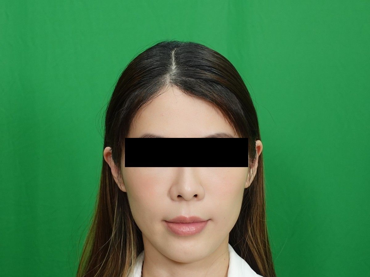 女性正面髮際線術前與術後約 9 個月，術後