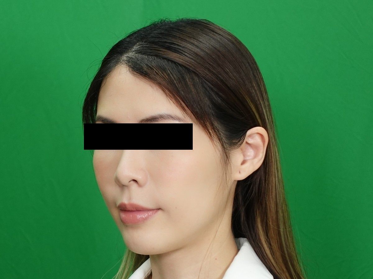女性左前側髮際線術前與術後約 9 個月，術後