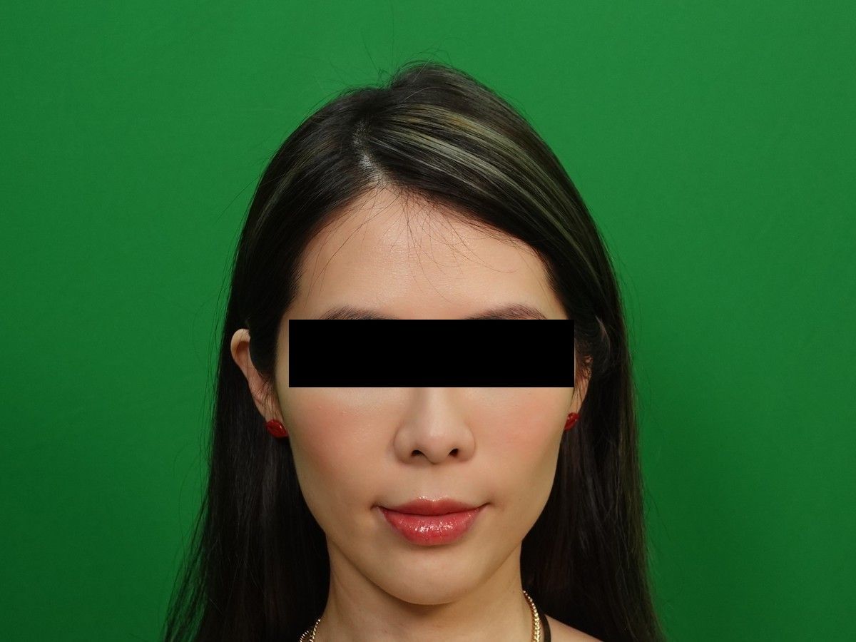 女性正面髮際線術前與術後約 9 個月，術前