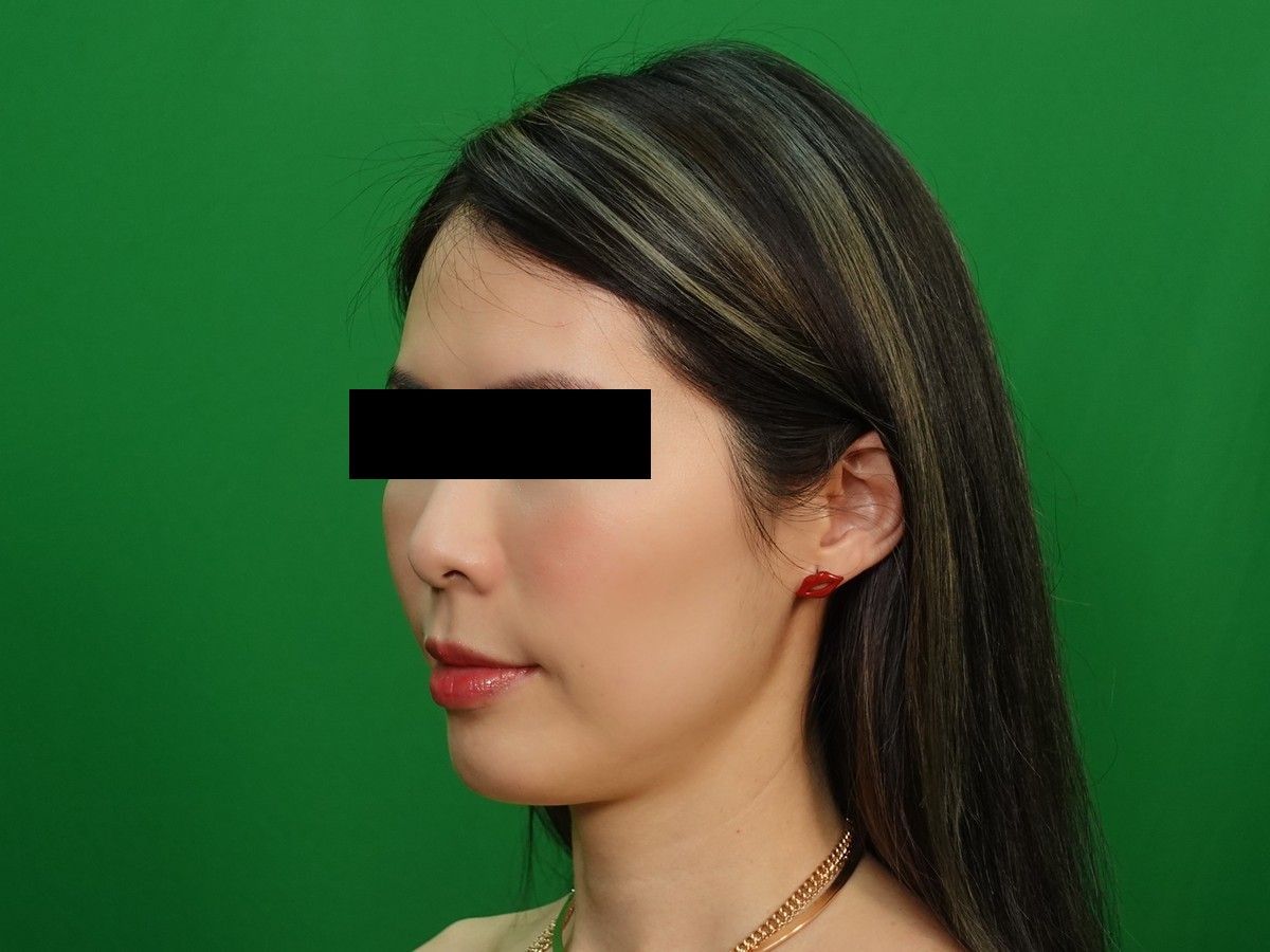 女性左前側髮際線術前與術後約 9 個月，術前