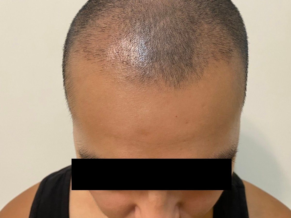 約 30 多歲男性前額植髮術後約 4 個月前額俯視影像，已遮蔽眼部