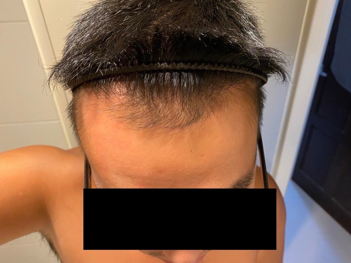 約 30 多歲男性前額植髮術後約 8 個月前額俯視影像，已遮蔽眼部