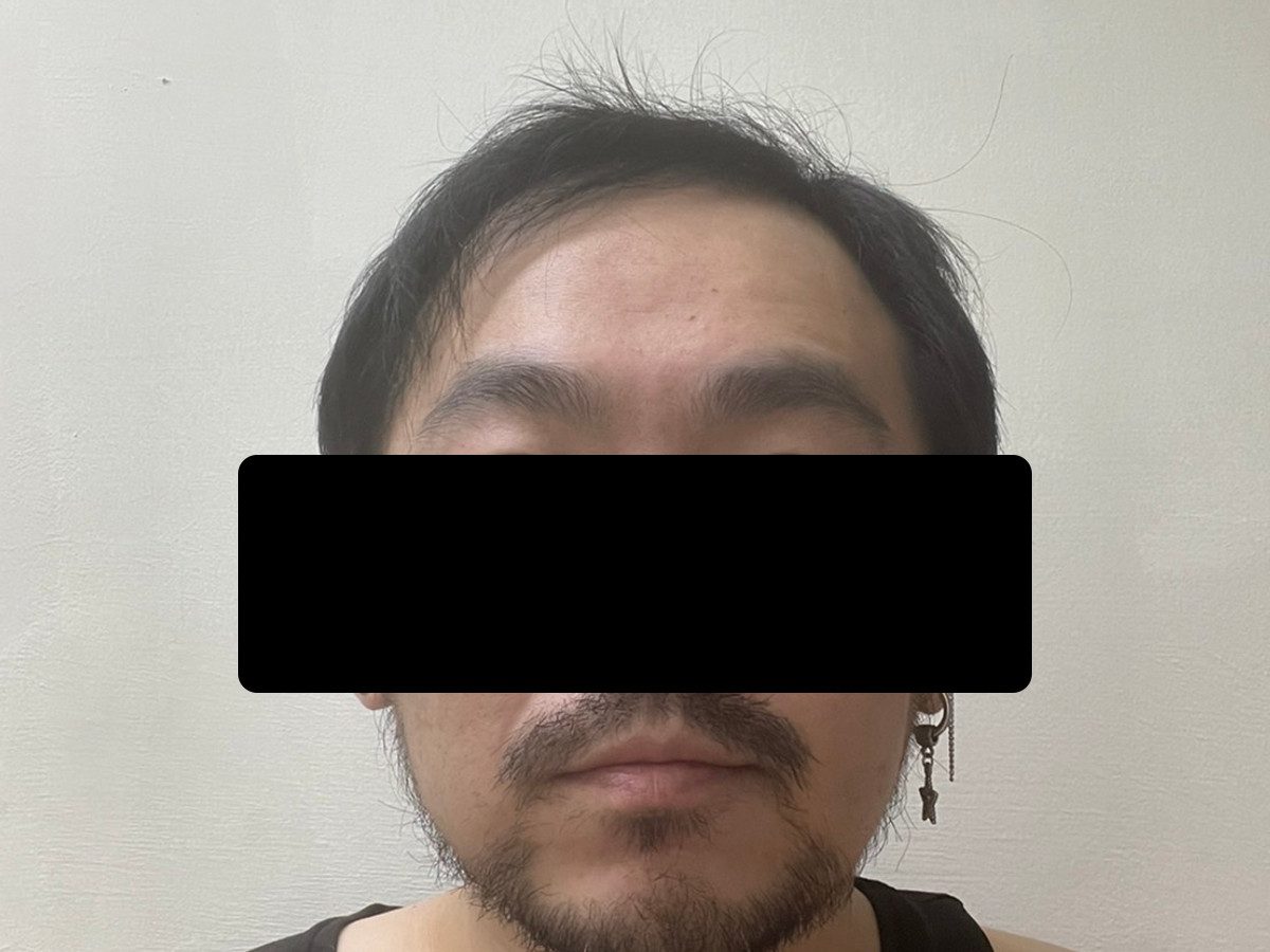 男性前額植髮術後約 10 個月正面髮際線影像，已遮蔽眼部