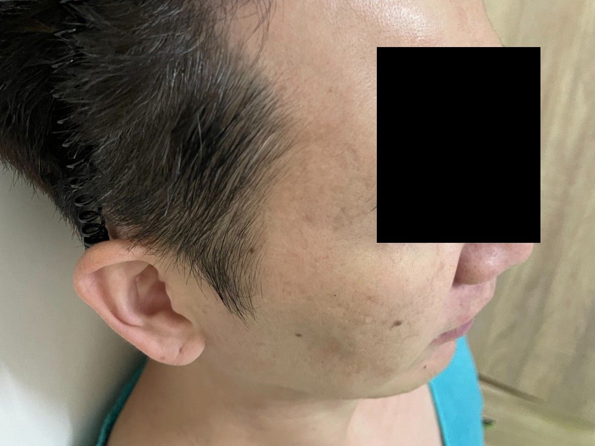 約 40 多歲男性髮際線植髮術後約 12 個月右側額角影像，已遮蔽眼部