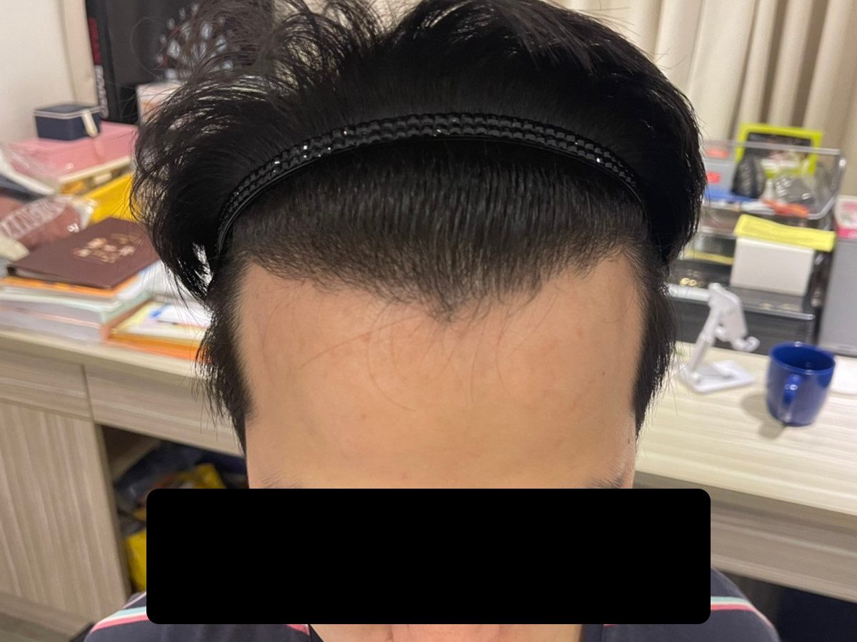 男性前額植髮術後約 13 個月正面髮際線俯視影像，已遮蔽眼部