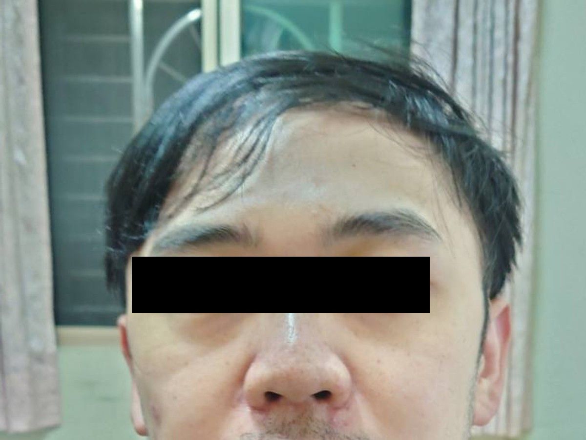 約 30 多歲男性髮際線植髮術後約 15 個月正面影像，已遮蔽眼部