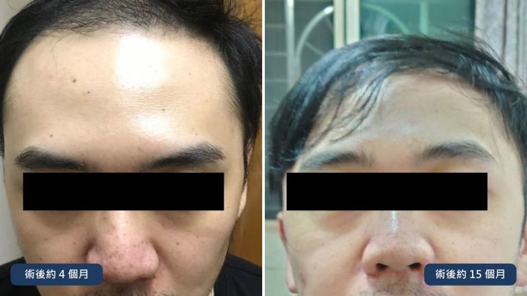 約 30 多歲男性髮際線植髮術後約 4 個月與約 15 個月正面比較，已遮蔽眼部