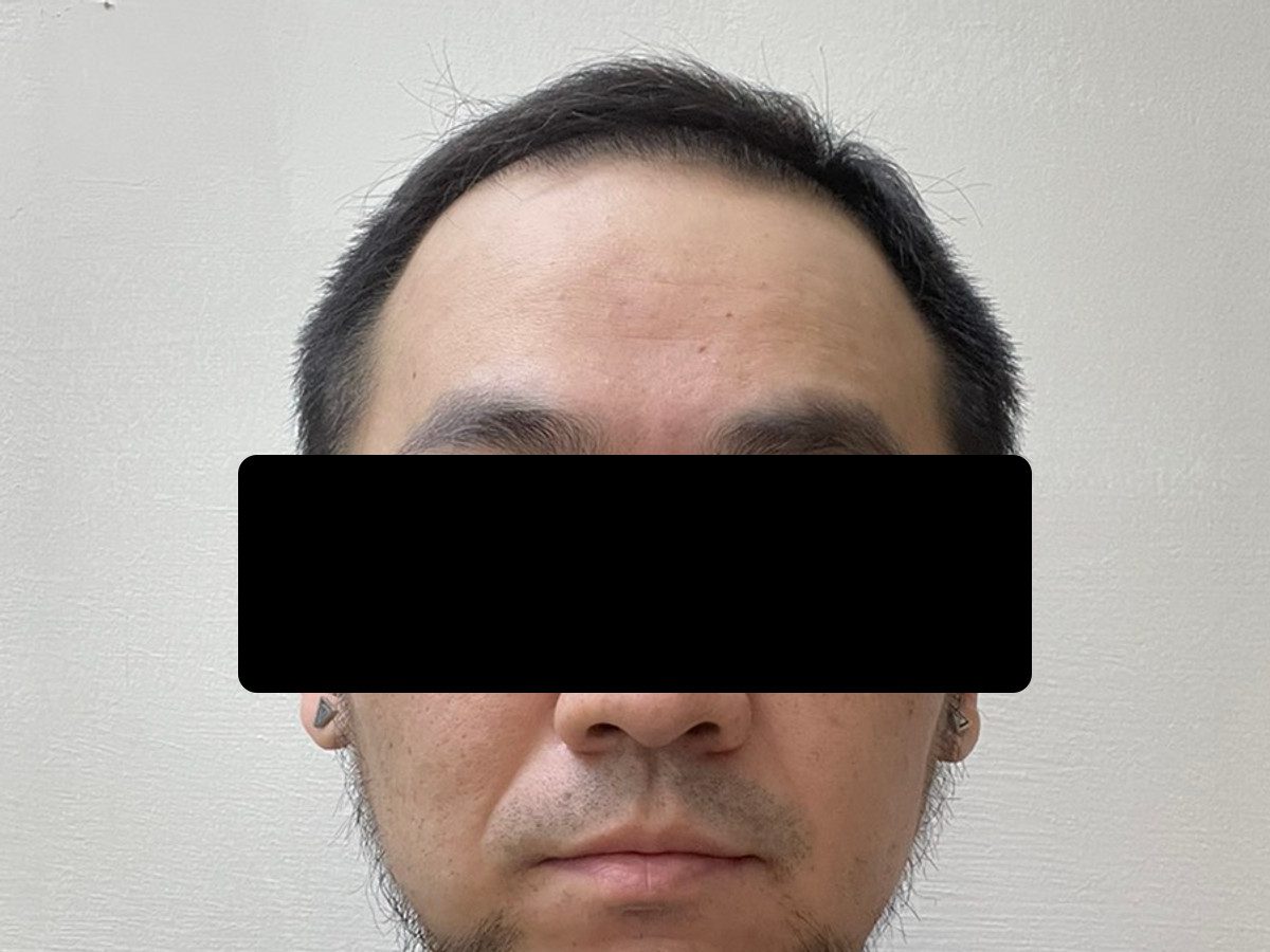 男性前額植髮術後約 4 個月正面髮際線影像，已遮蔽眼部