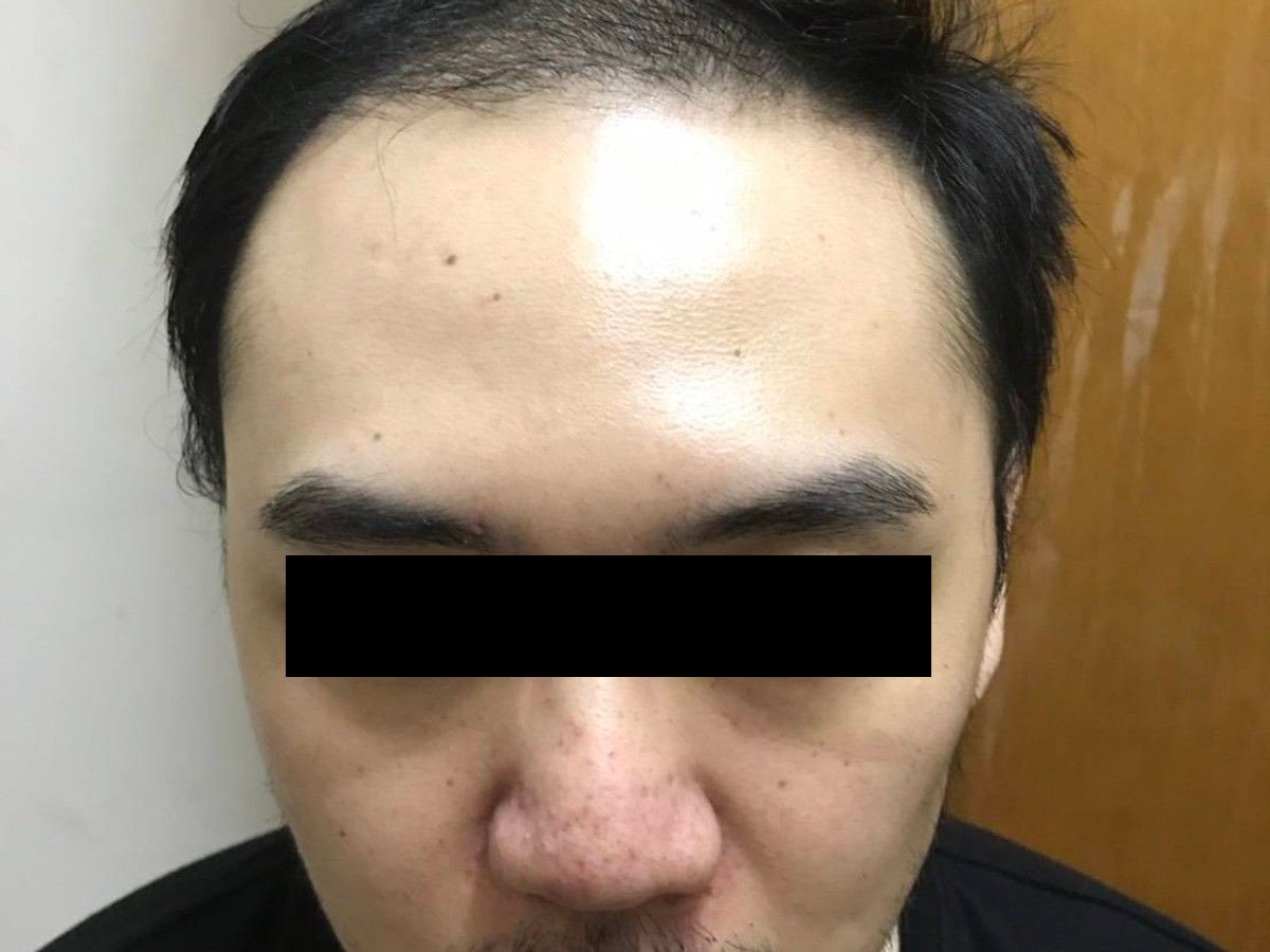 約 30 多歲男性髮際線植髮術後約 4 個月正面影像，已遮蔽眼部