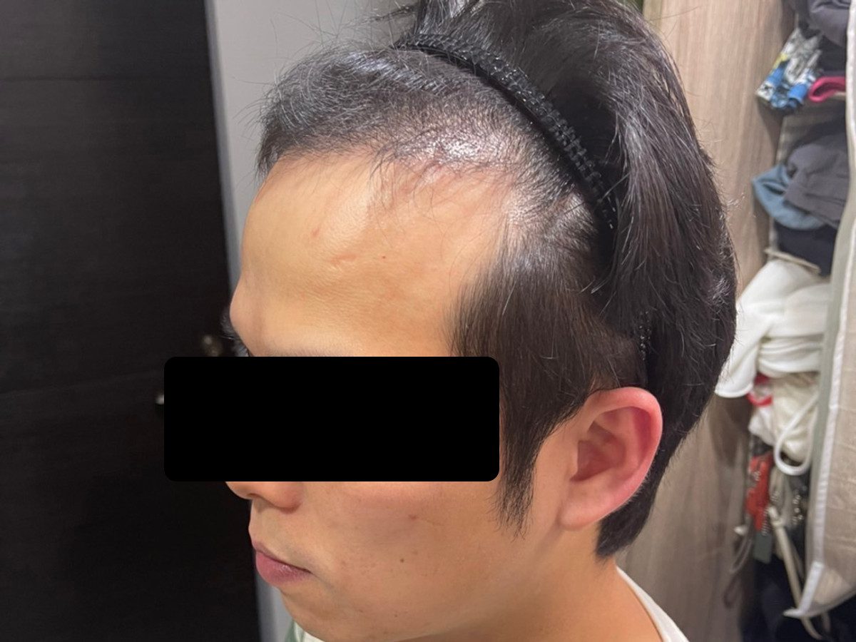 男性前額植髮術後約 6 個月左側額角影像,已遮蔽眼部