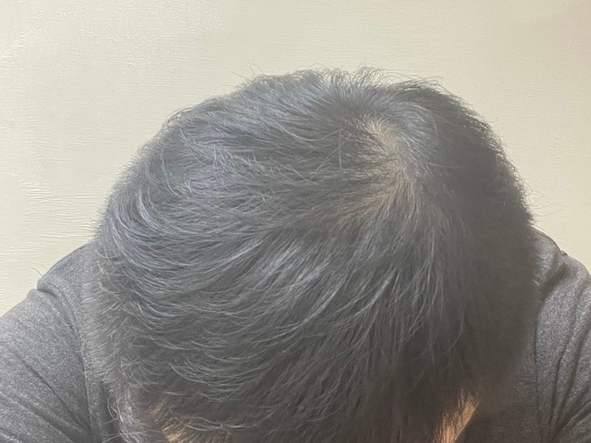 男性植髮術後約 6 個月中央頭皮與髮旋俯視影像