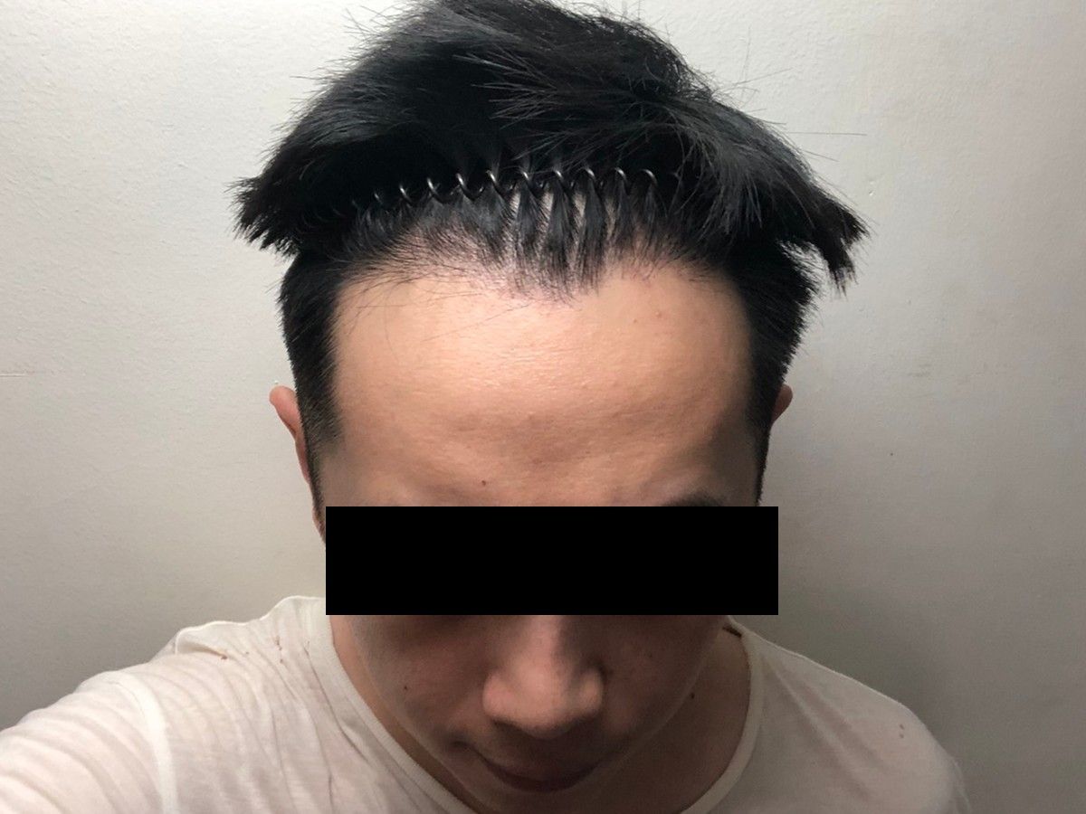 M 型額角正面髮際線術前與術後約 7 個月:植髮後