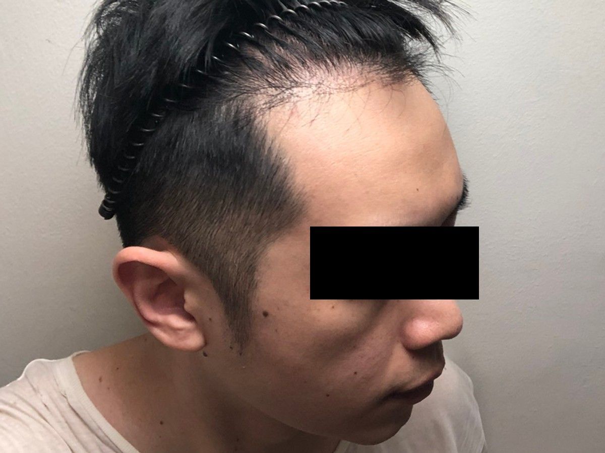 M 型右側額角術前與術後約 7 個月:植髮後