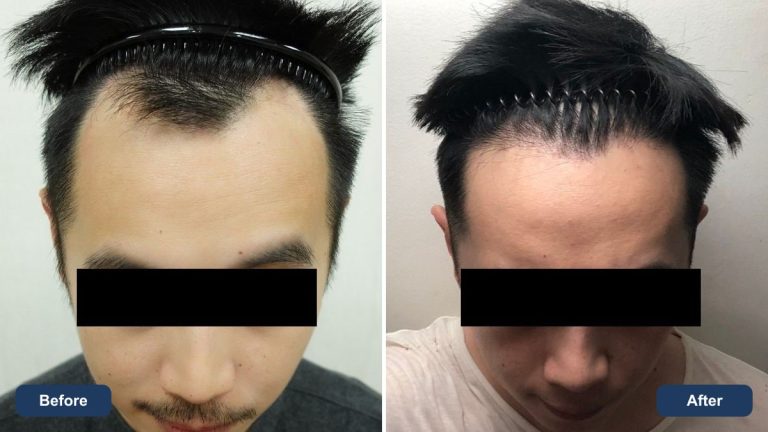 約 30 多歲男性 M 型髮際線植髮術前與術後約 7 個月正面比較，已遮蔽眼部