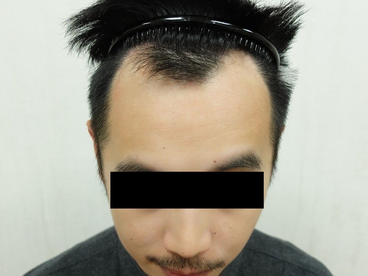 M 型額角正面髮際線術前與術後約 7 個月:植髮前