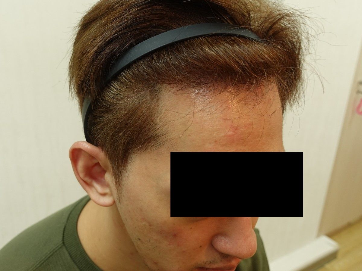 右側額角術前與術後約 7 個月，術後