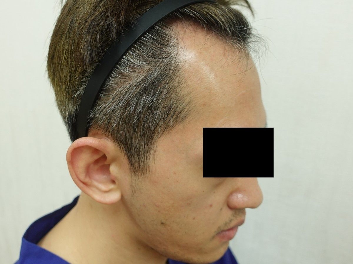 右側額角術前與術後約 7 個月,術前