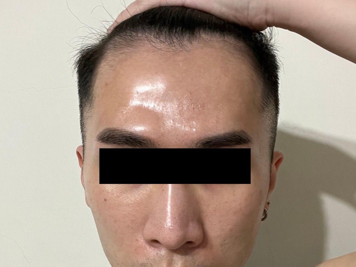 約 20 多歲男性額角植髮術後約 12 個月正面影像，已遮蔽眼部