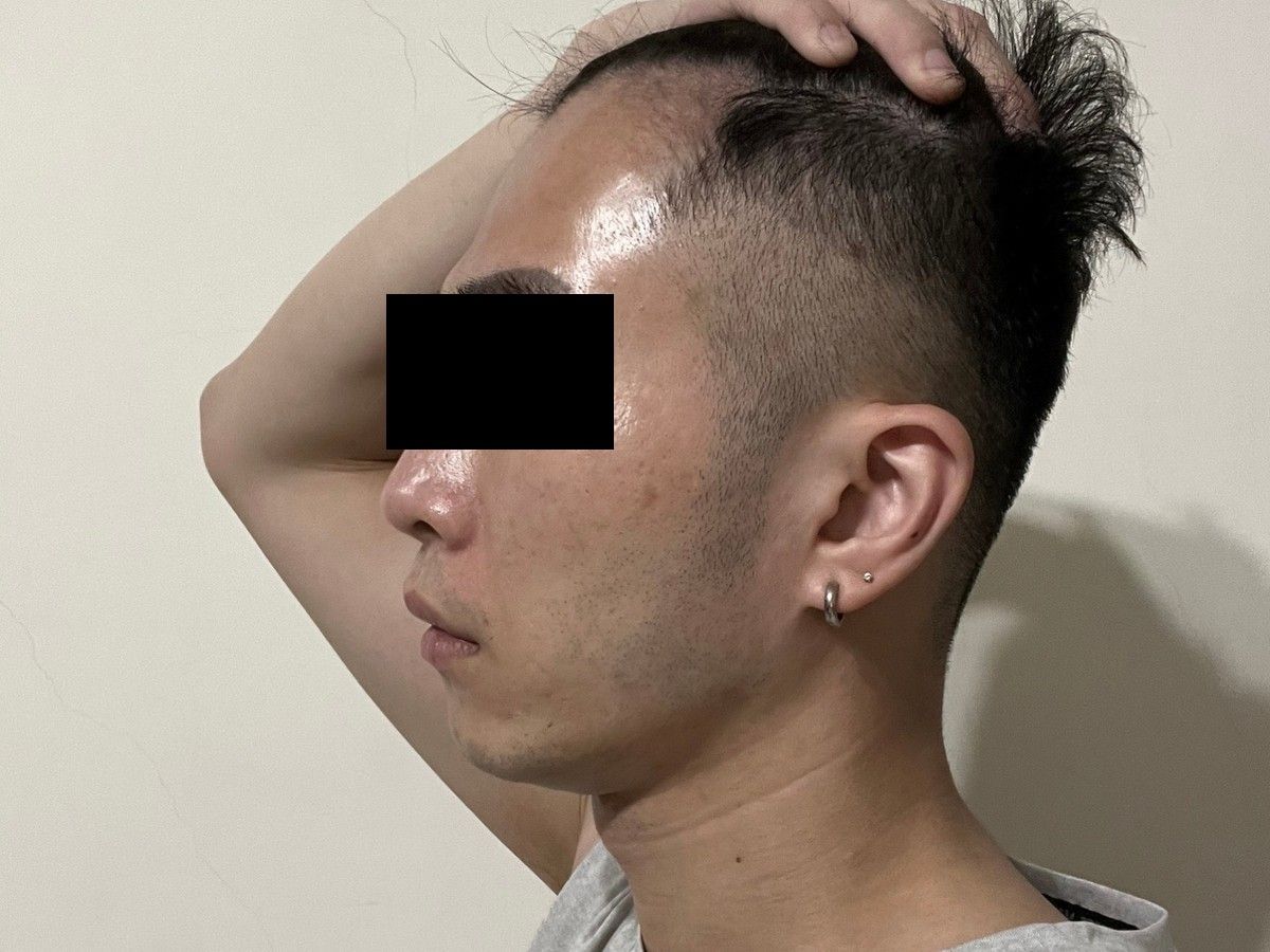約 20 多歲男性額角植髮術後約 12 個月左側額角影像，已遮蔽眼部
