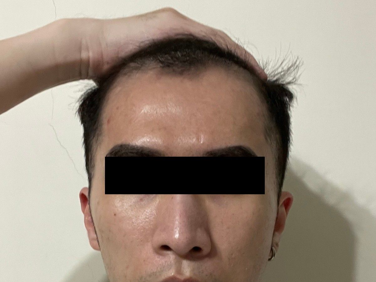 約 20 多歲男性額角植髮術後約 6 個月正面影像,已遮蔽眼部