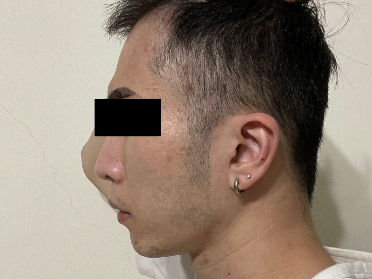 約 20 多歲男性額角植髮術後約 6 個月左側額角影像,已遮蔽眼部